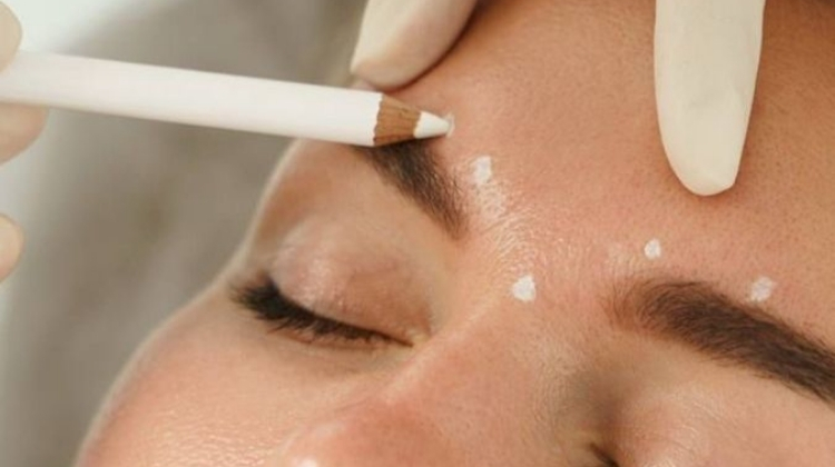 ბოტულინოთერაპია