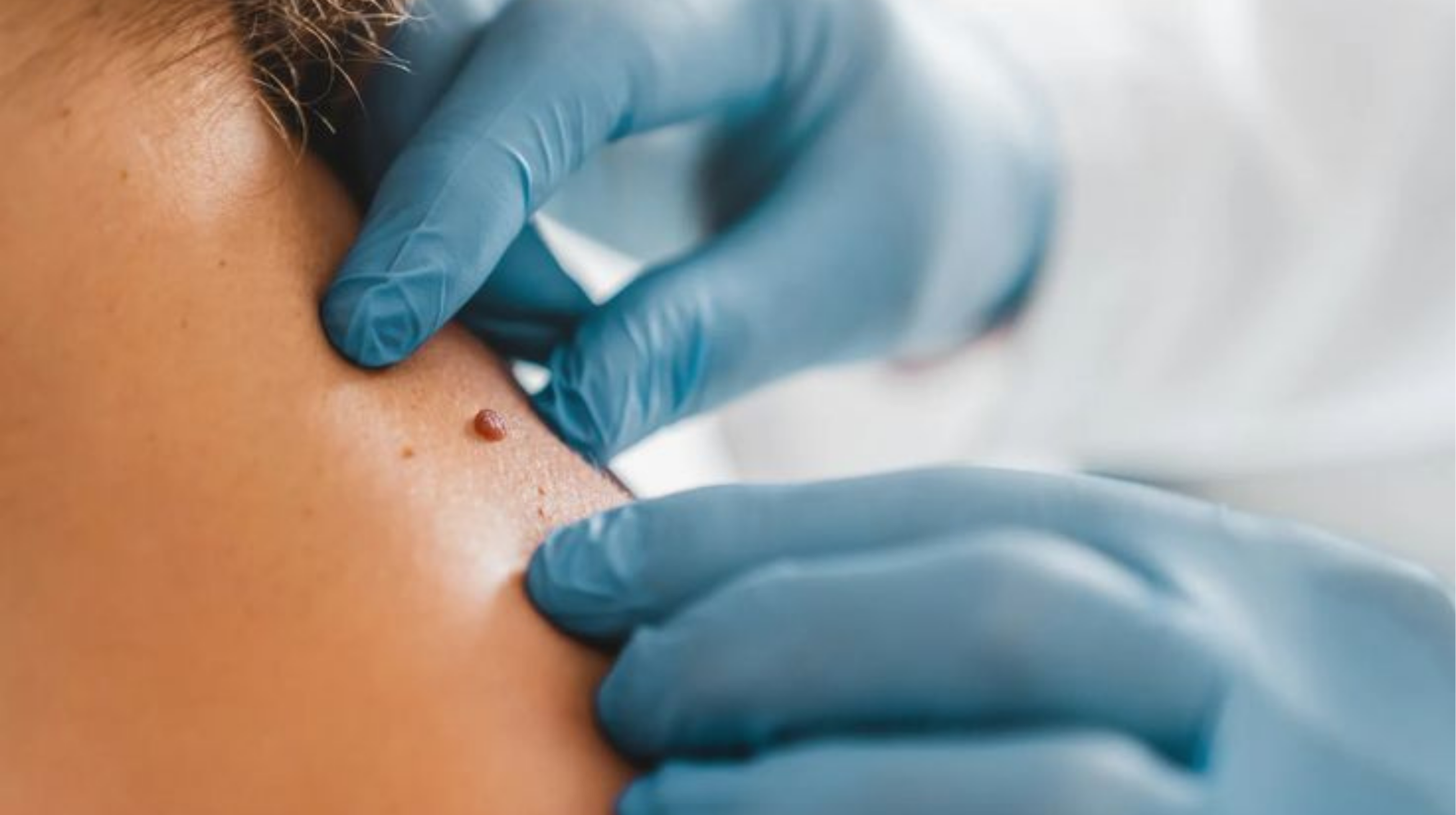 პაპილომების, კერატომებისა და  ხალების მოშორება